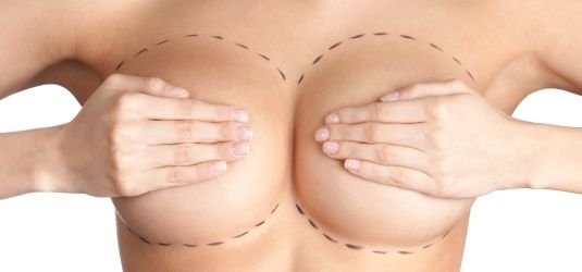 Weibliche Brust vor der Entfernung von Implantaten (Symbolbild)