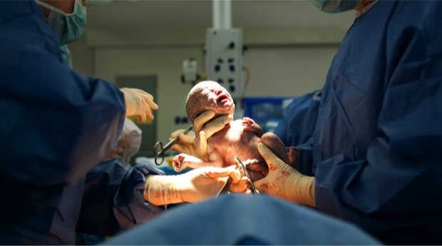 Eine Entbindung mittels Kaiserschnitts (Symbolbild)